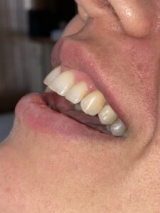 ایمپلنت دندان در کلینیک رازی