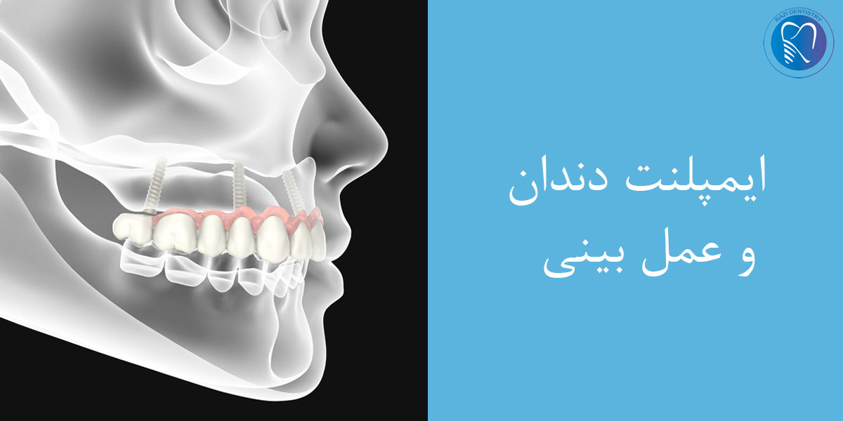 ایمپلنت دندان و عمل بینی